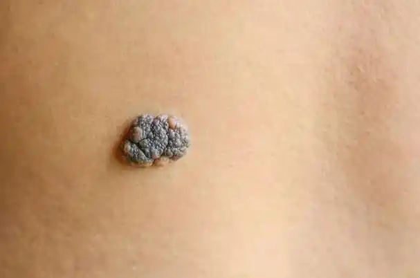 d直径(diameter):>色素痣直径>5~6毫米或明显长大时要注意,黑色素瘤