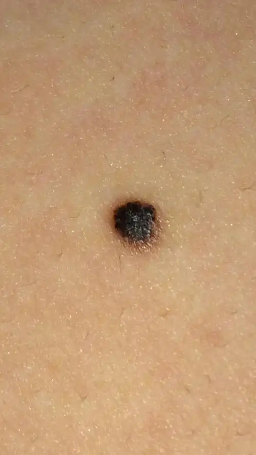 这颗痣感觉变大了一点,会是黑色素瘤吗?图1昨天拍的图2今天拍的.