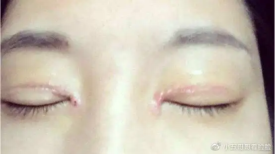 想做双眼皮 开眼角,做好这6点,让疤痕增生远离你!疤痕体质必读攻略