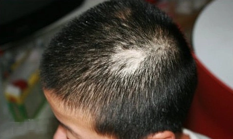 什么是脂溢性脱发?