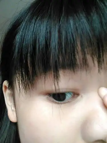 我眼睛旁边有个洞,怎么回事