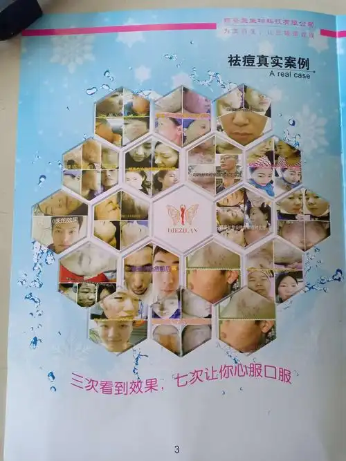 蝶姿兰祛痘真实案例分享