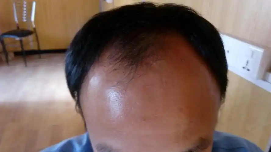 我今年31岁头发就已经这样子了,我觉得前额油还有点痒,我脱发有个4/5