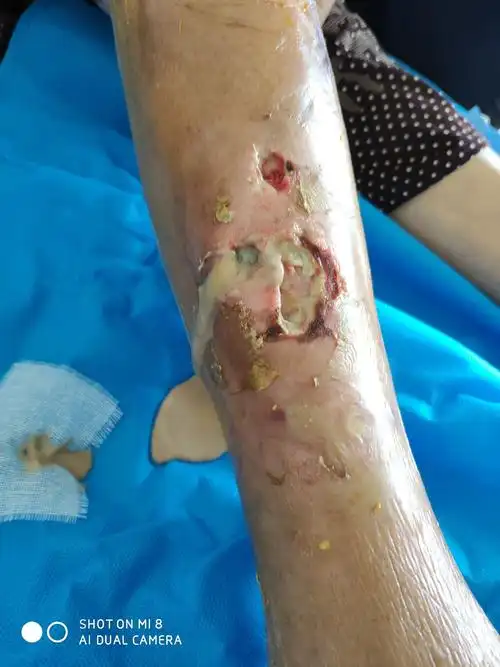 切开浅表筋膜层可见大量黄色脓液流出.