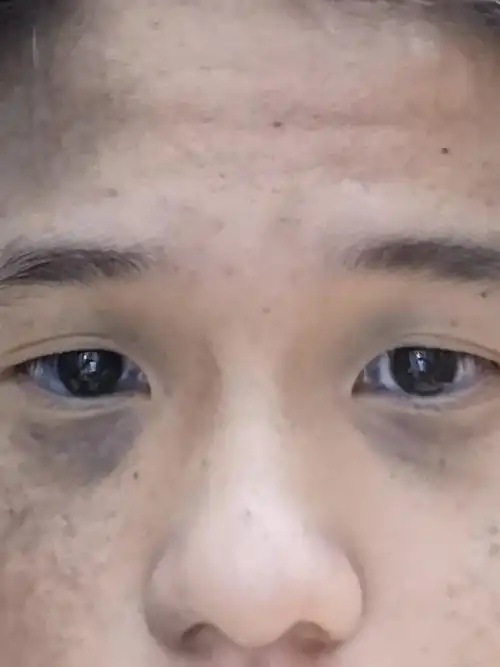 一长大没用眼霜,消不掉黑眼圈怎么办?