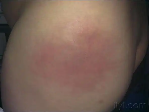 孕晚期左臀部蜂窝组织炎