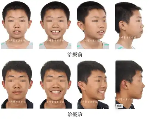 把握生长发育期,突面型男孩变直面小帅哥