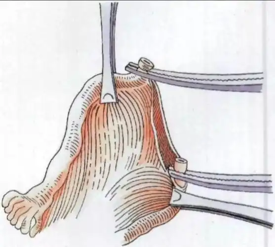 【孕育指南】输卵管结扎复通术,找回你的二次"生机"!