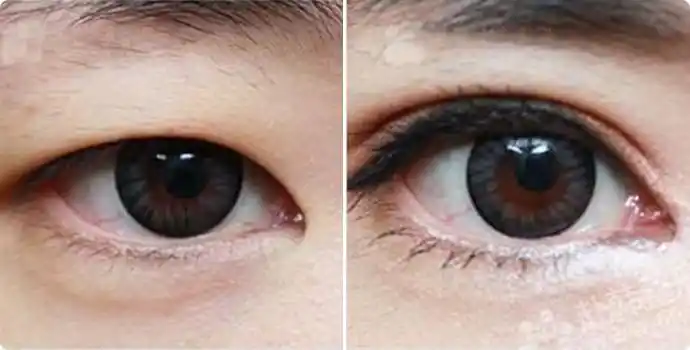 开内眼角前后对比图开内眼角效果图开内眼角前后对比照片