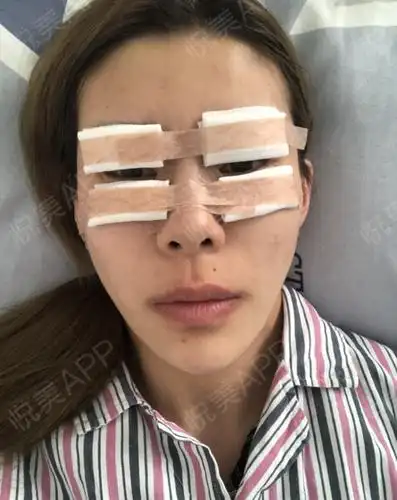 眼部多项手术当天_眼型矫正手术当天_眼部多项手术当天_开眼角手术