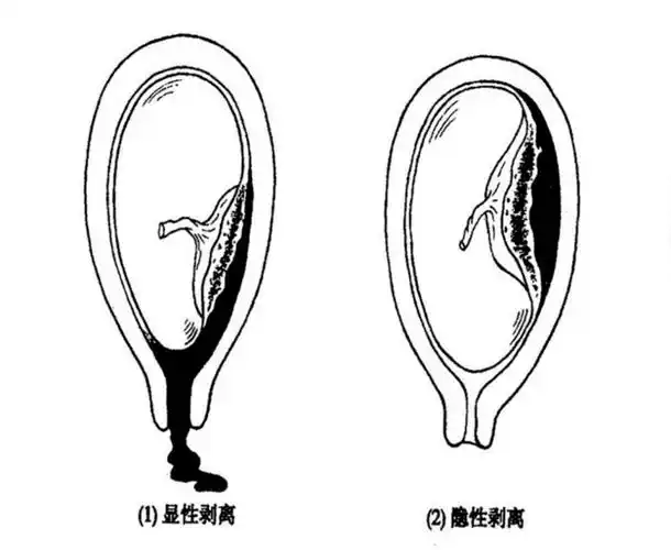 世界子痫前期日科普之五——胎盘早剥
