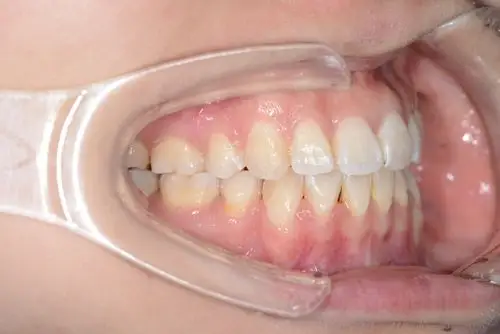 我把牙齿角度都救回来了,牙齿咬合也做到尖窝交错