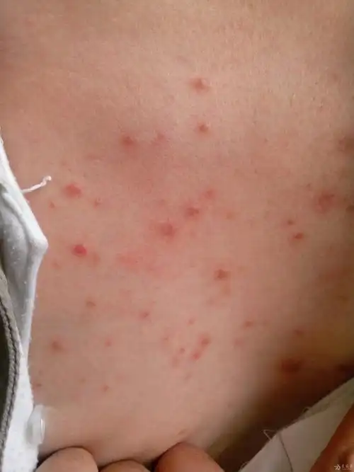 还有一例胸前丘疹的