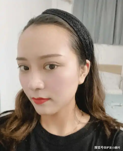 我回归的发际线教你发际线后移怎么办