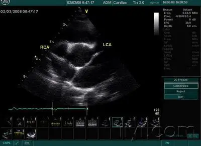 双侧冠状动脉瘤