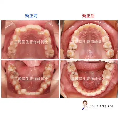骨性上颌前突,下颌后缩-青少年矫正案例