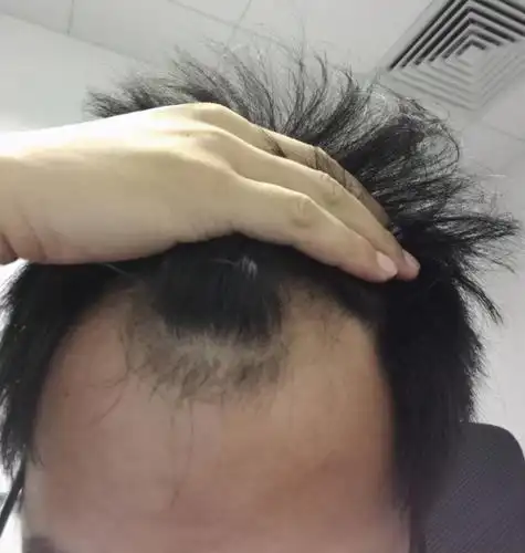 22岁小伙掉发3年不到两额角已经凹进去从没敢留过寸头