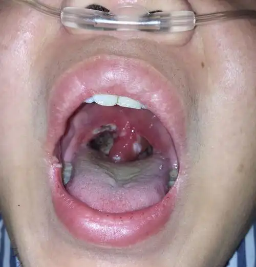 切扁桃体之后是什么感觉