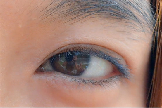 正常人的眼白上只分布着少量的毛细血管,没有其他的异物.