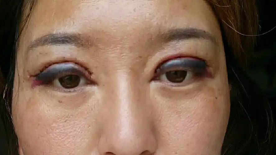 我的大眼综合失败过程