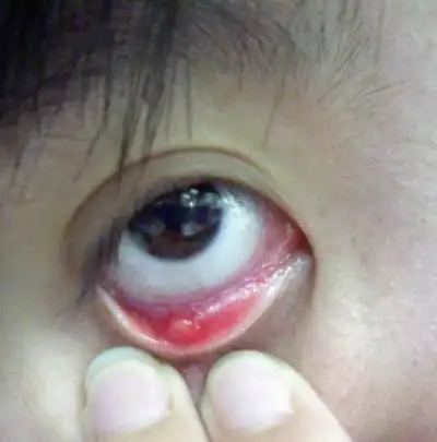 麦粒肿症状和预防