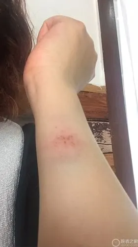 手臂受伤了,手表也跟着遭殃 这样的情况怎么处理呢