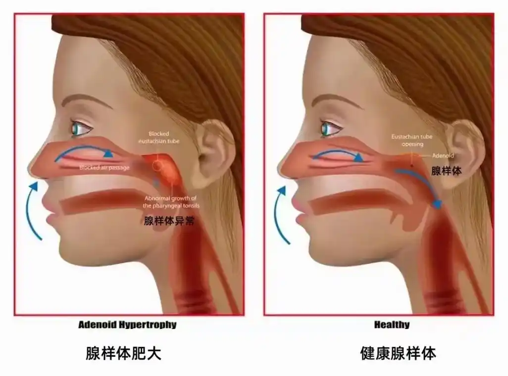 扁桃体肿大,腺样体肥大,鼻炎.腺体样肥大,扁体桃,鼻炎是铁三 - 抖音