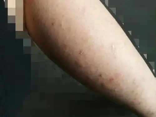 被螨虫咬了该怎么办,感觉我从膝盖以下的部分都要废了,好多包,留疤的