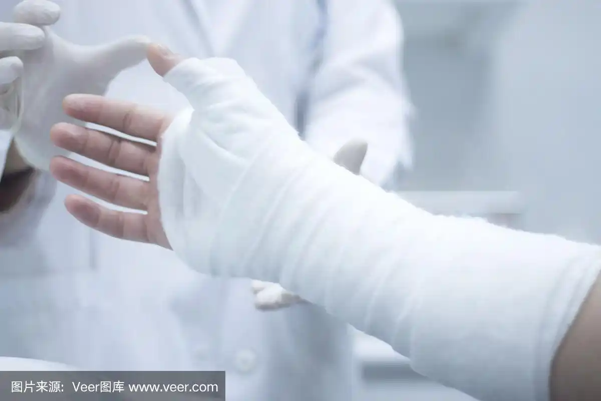 骨折后,医生在患者前臂和手腕上使用石膏石膏和绷带固定.