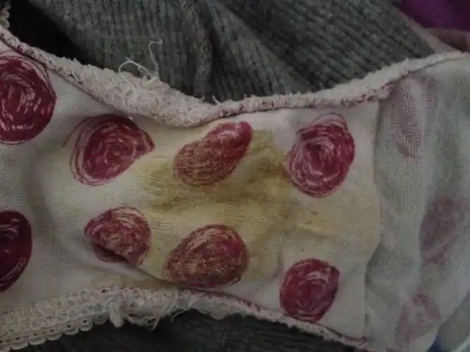 白带干了以后发黄,一天的量多,有股腥臭味.但是没有瘙痒等不良症状.