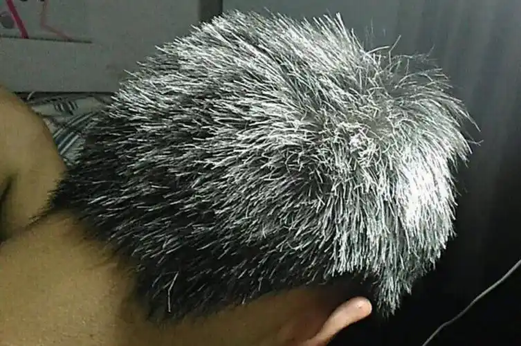 67少白头和一夜白头到底是怎么回事