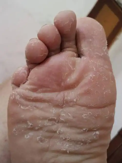 你看我脚这是怎么了,用什么药可以治好