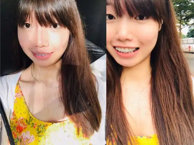 戴牙套10个月的牙套脸凹凸脸01