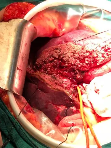 黔江中心医院肝胆手术全微创之路(一)