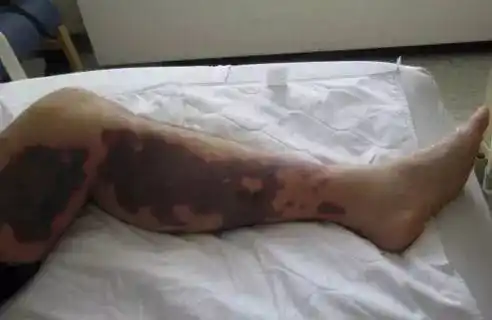 可见因吸食勾兑杂质毒品造成的皮肤溃烂冰毒是新型合成毒品最典型的