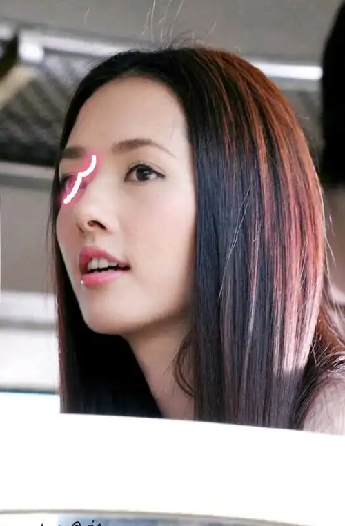 混血儿就会有驼峰鼻吗?