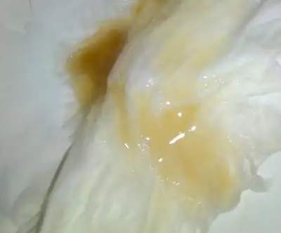 死精的症状图片54