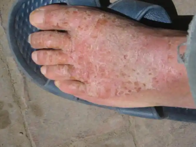 糜烂型足癣图片是什么样的?