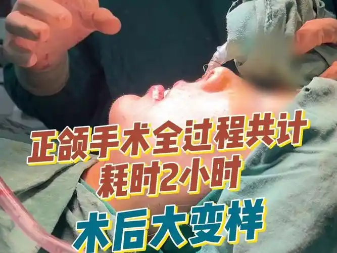正颌手术全过程共计耗时2小时术后大变样