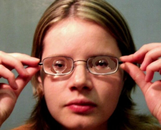 高度超高度近视需注意这些问题