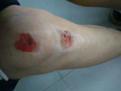 骑摩托车时,摔了,膝盖被擦伤了怎么办?