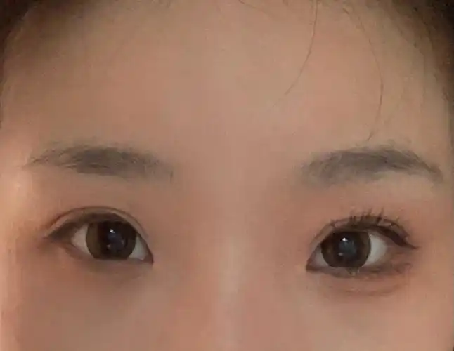 最成功的一次眼睑下至