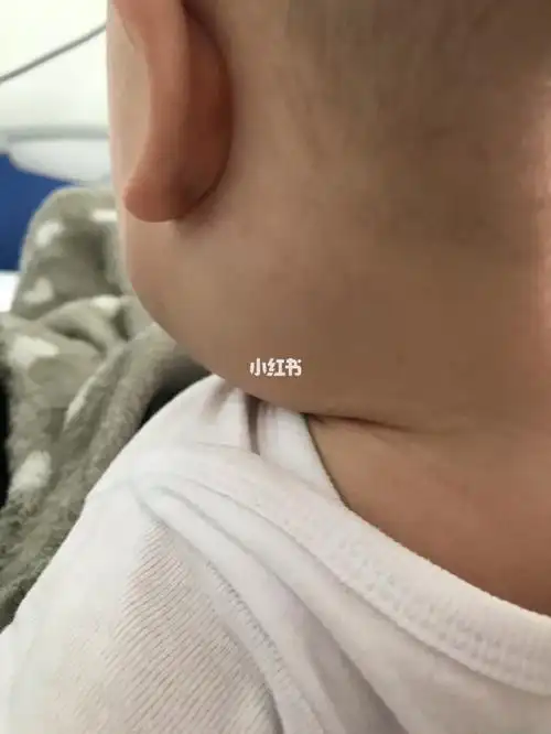 5 个月宝宝 耳朵下面淋巴结肿大 不知道什么原因 摸过去会哭