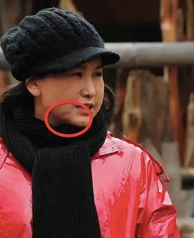 46岁王茜近照曝光 面部凹凸不平疑似整容