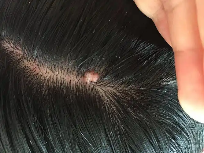 最近两年张了个肉疙瘩在头顶上,以前一直以为是痣,自己怀疑是脂肪瘤