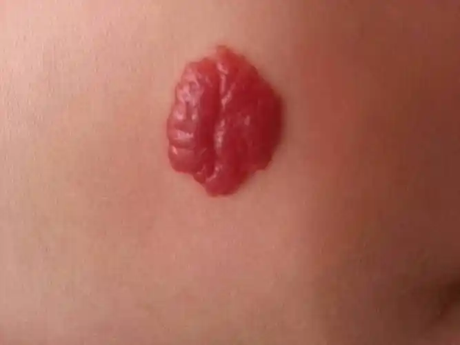 血管瘤应该如何科学治疗 _新闻_大夫e站