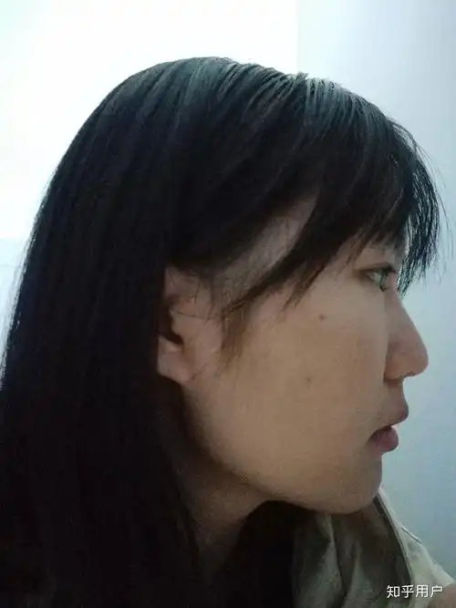 侧脸很平啊怎么办啊感觉脸就是一条线下去了特别丑眼睛近视还突嘴也突