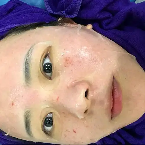 记录第一次微针加激光治疗毛孔