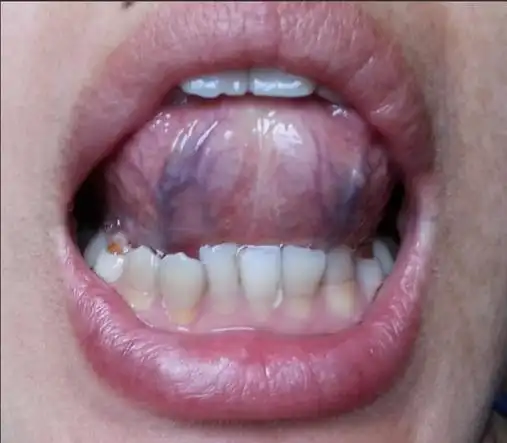 淤血体质的辨别与解决方法