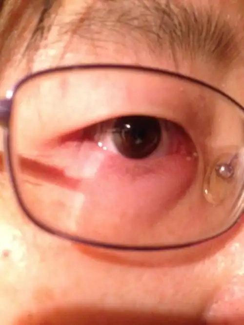 眼睛发红是怎么回事眼睛经常红是什么原因